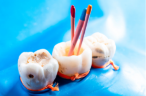 Imagem ilustrativa de tratamento endodontico